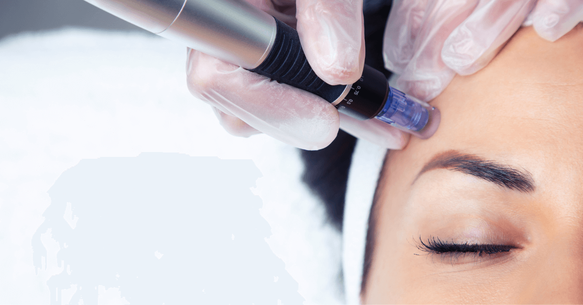 Woman get Microneedling treatment on her face